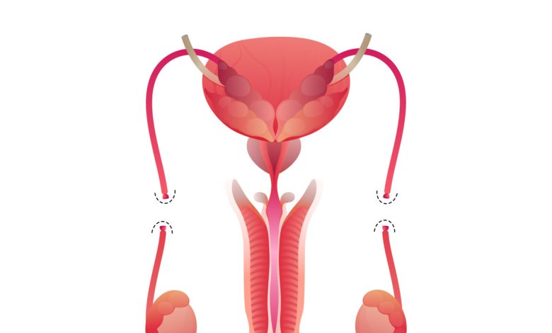 Vantagens e desvantagens da vasectomia